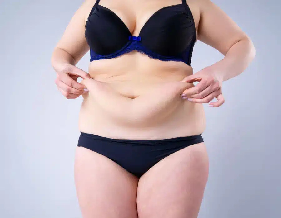 cirurgia pos bariatrica